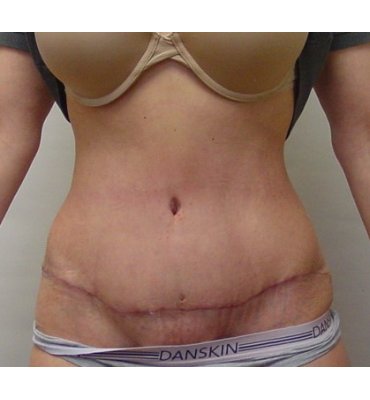 abdominoplasty after